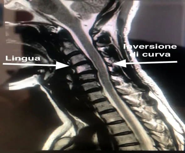 RM del raquis cervical con inversión de la curva fisiológica y lengua posteriorizada
